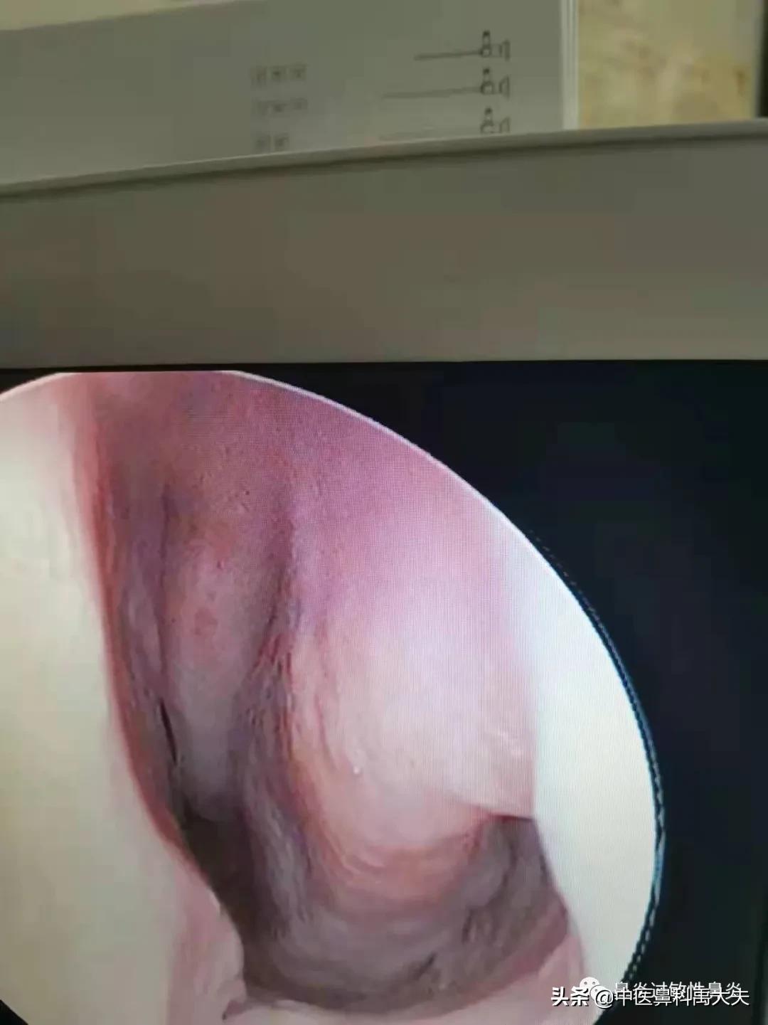 鼻炎的症状和治疗最好方法,常见萎缩性鼻炎或干燥性鼻炎症状