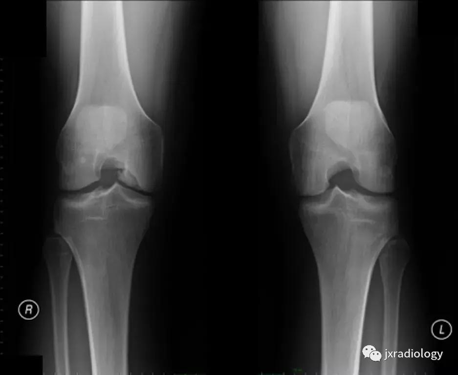 磁共振天天诊断骨髓水肿，但您知道原因吗？