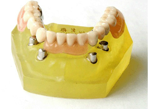 各类假牙价格,最便宜的假牙多少钱一颗