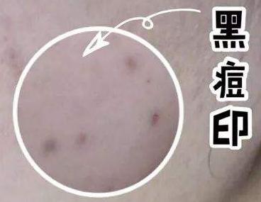 痘痘不挤痘印消不掉吗,红色痘印一直消不掉