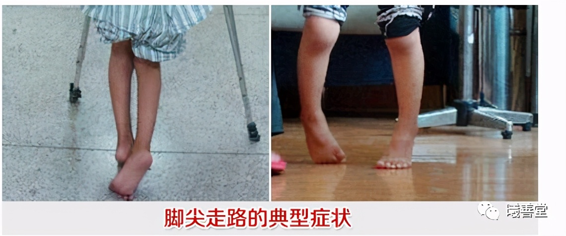 小儿脑瘫康复治疗该怎么做,小儿脑瘫康复治疗方法是什么