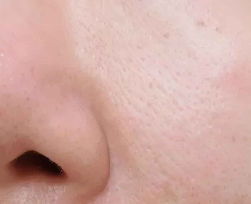 毛孔粗大别怕有办法,毛孔粗大了十几年还有救吗