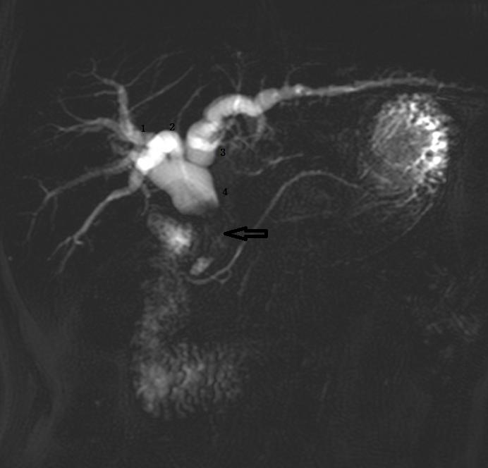 胆道系统解剖生理讲课视频,超声胆道系统的解剖生理