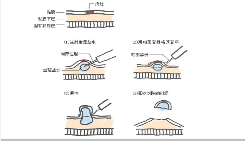 多发息肉和单发息肉哪个容易癌变,分叶息肉和带蒂息肉哪个容易癌变
