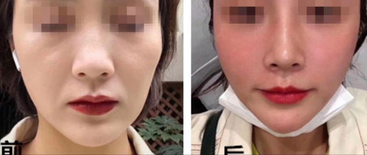 热玛吉抗衰技术可靠吗,超声炮和热玛吉哪个抗衰效果好