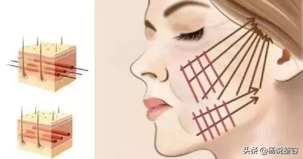 脸上的法令纹越来越深是什么原因,法令纹太明显怎么改善小技巧
