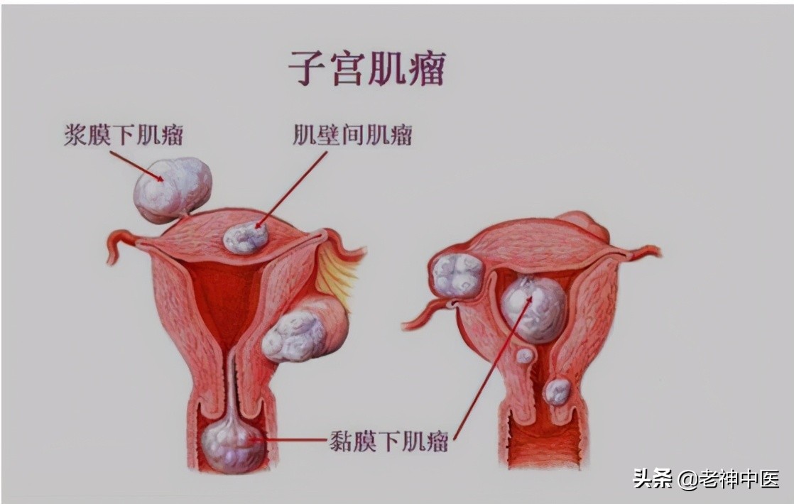 子宫肌瘤痛经肾阳虚,子宫肌瘤引起月经多贫血怎么办