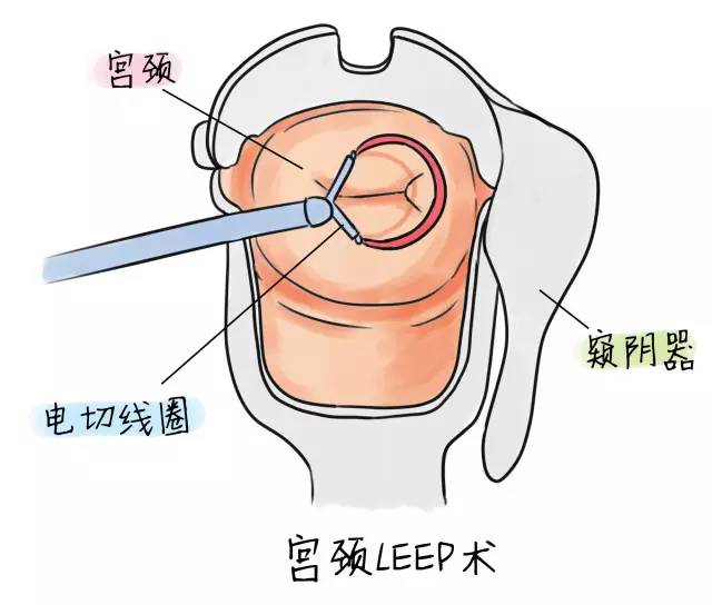 宫颈糜烂10分钟红光治疗危害,宫颈糜烂中医怎么治疗效果最好