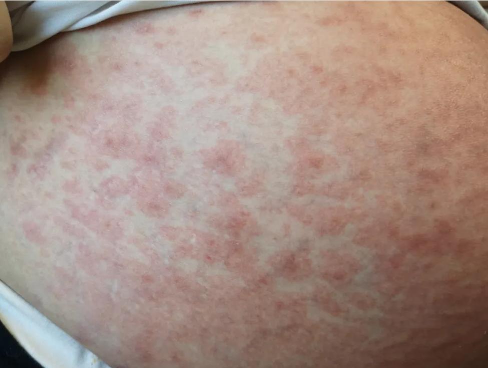 怀孕期间肚皮痒有红斑是怎么回事,孕晚期妊娠瘙痒性丘疹怎么治疗