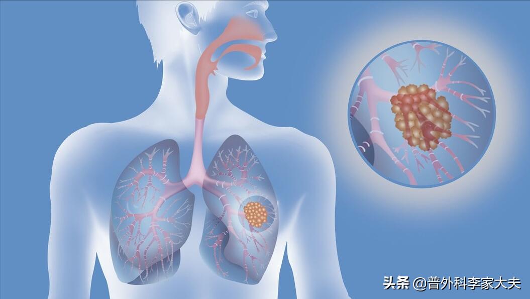 8mm磨玻璃结节早期肺癌会复发吗,早期肺癌的人肺癌会复发吗