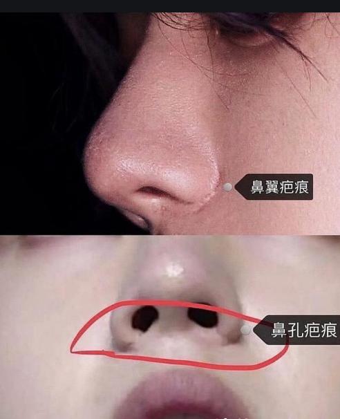 盘点一些有问题的鼻子,明星都没整好的鼻子