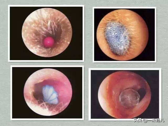 小孩的耳朵怎么护理,宝宝耳朵有异物医生怎么洗