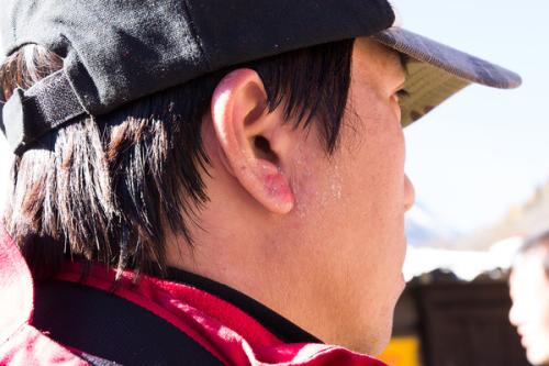 被太阳晒伤后怎么最快的修复,太阳晒伤皮肤怎么好得快