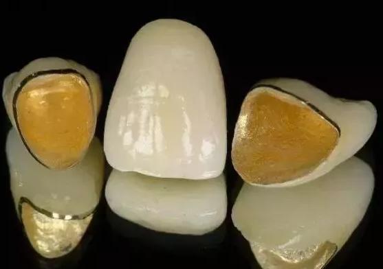 烤瓷牙修复缺陷图片,做了烤瓷牙后悔了有补救办法吗