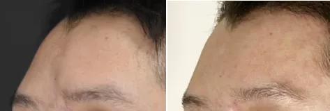 打耳洞耳朵增生,只要打耳洞就会耳洞增生