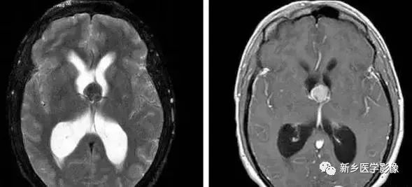 影像学脑室扩大,脑室显大怎么理解