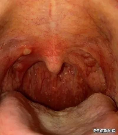 近期儿童咳嗽怎么治最快最有效,孩子咳嗽又犯了教你一招定位止咳