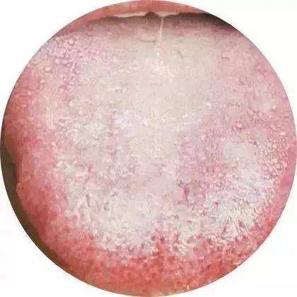 微白薄苔舌、白苔略厚苔舌，此无病之舌，无需用药