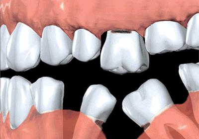 牙疼去医院一般怎么治疗,牙疼到半边脸痛去医院花多少钱