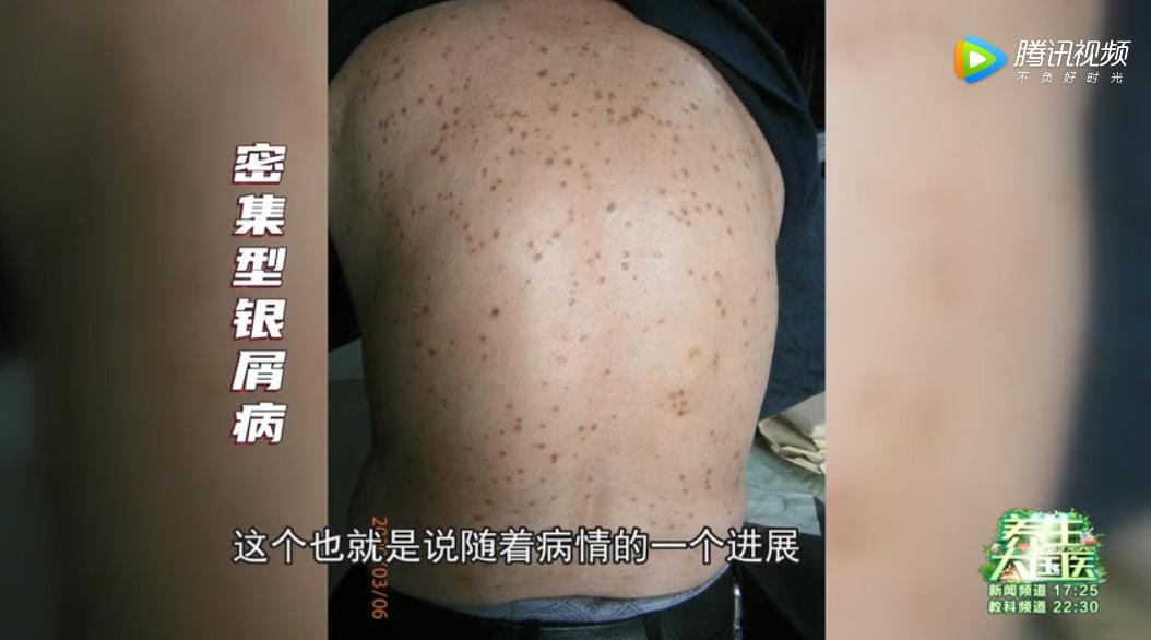 头皮发痒与体内疾病有关,头皮舌头发麻发木是什么病的前兆