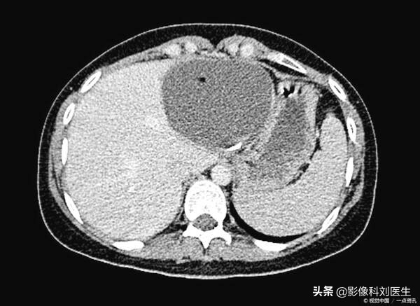 什么是肝囊肿？医生：别怕，它只是“水泡”