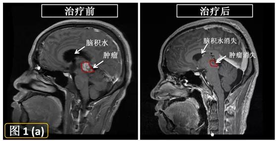 伽玛刀治疗能治愈哪些疾病,无形胜有形完整版