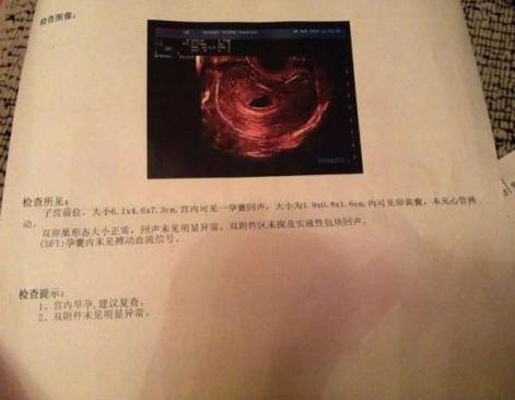 孕早期b超报告单都有什么,孕早期b超查不出来腹疼流血稍多