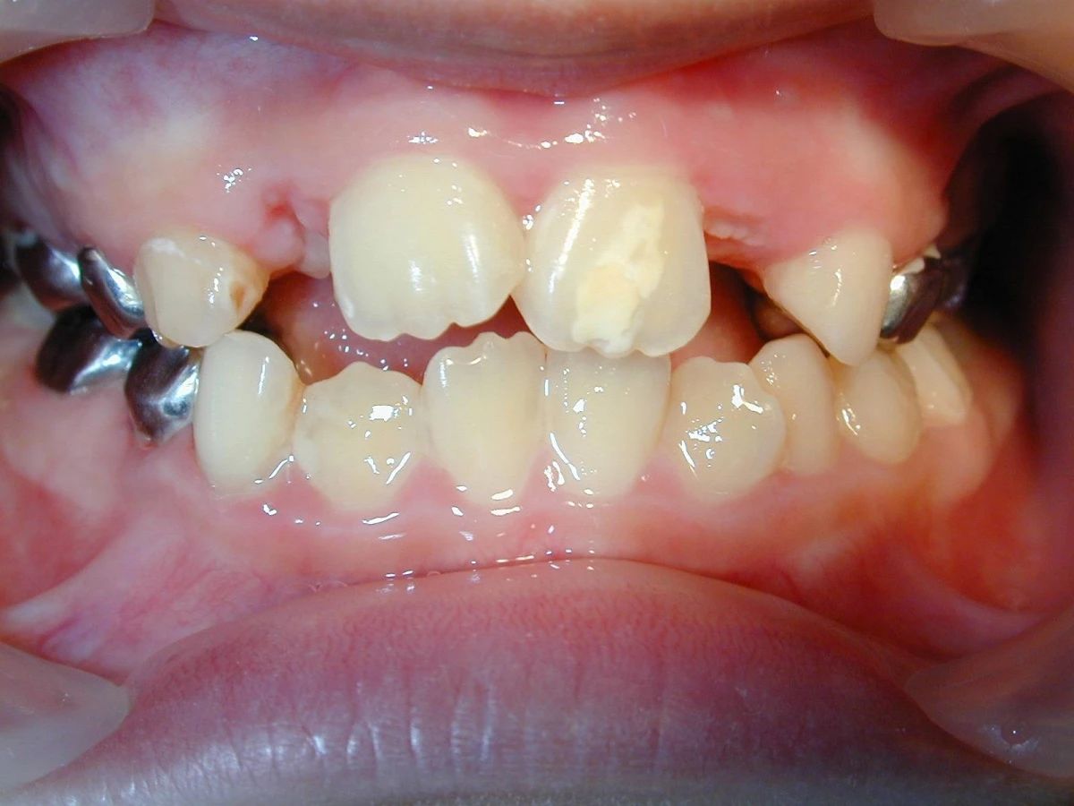 小孩换牙后牙齿钙化怎么挽救,牙齿钙化补钙有用吗