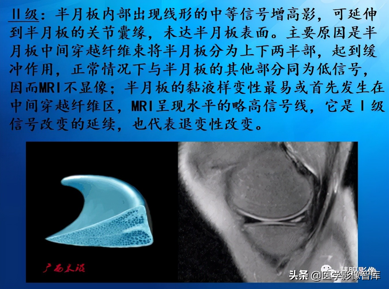 膝关节半月板损伤的解剖结构图,半月板mri解剖图解