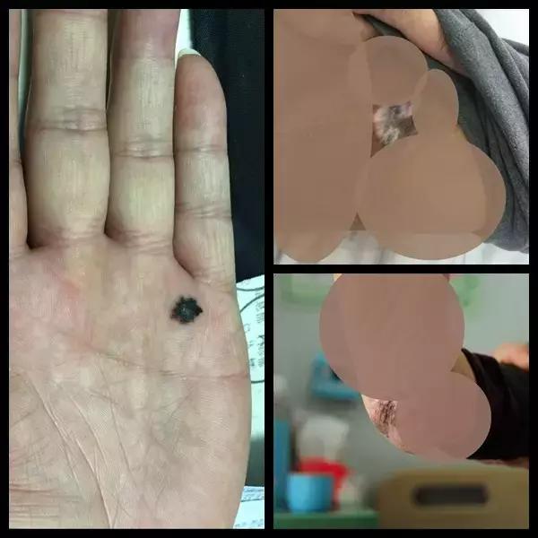 这些癌变信号别大意,这些癌前病变千万别忽略