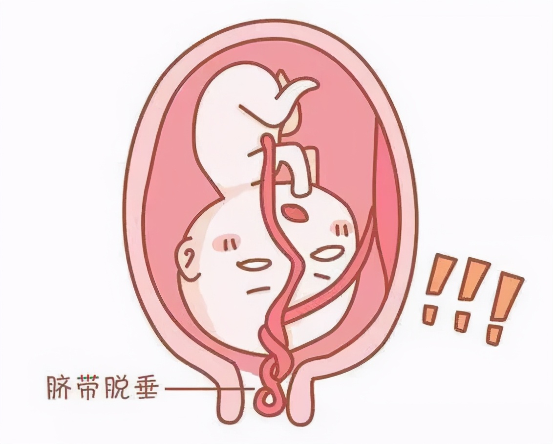 抢救脐带脱垂,产妇脐带脱垂7分钟紧急接力