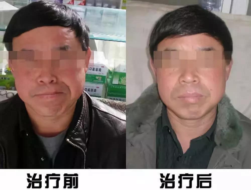 面瘫康复训练方法，八个小步骤