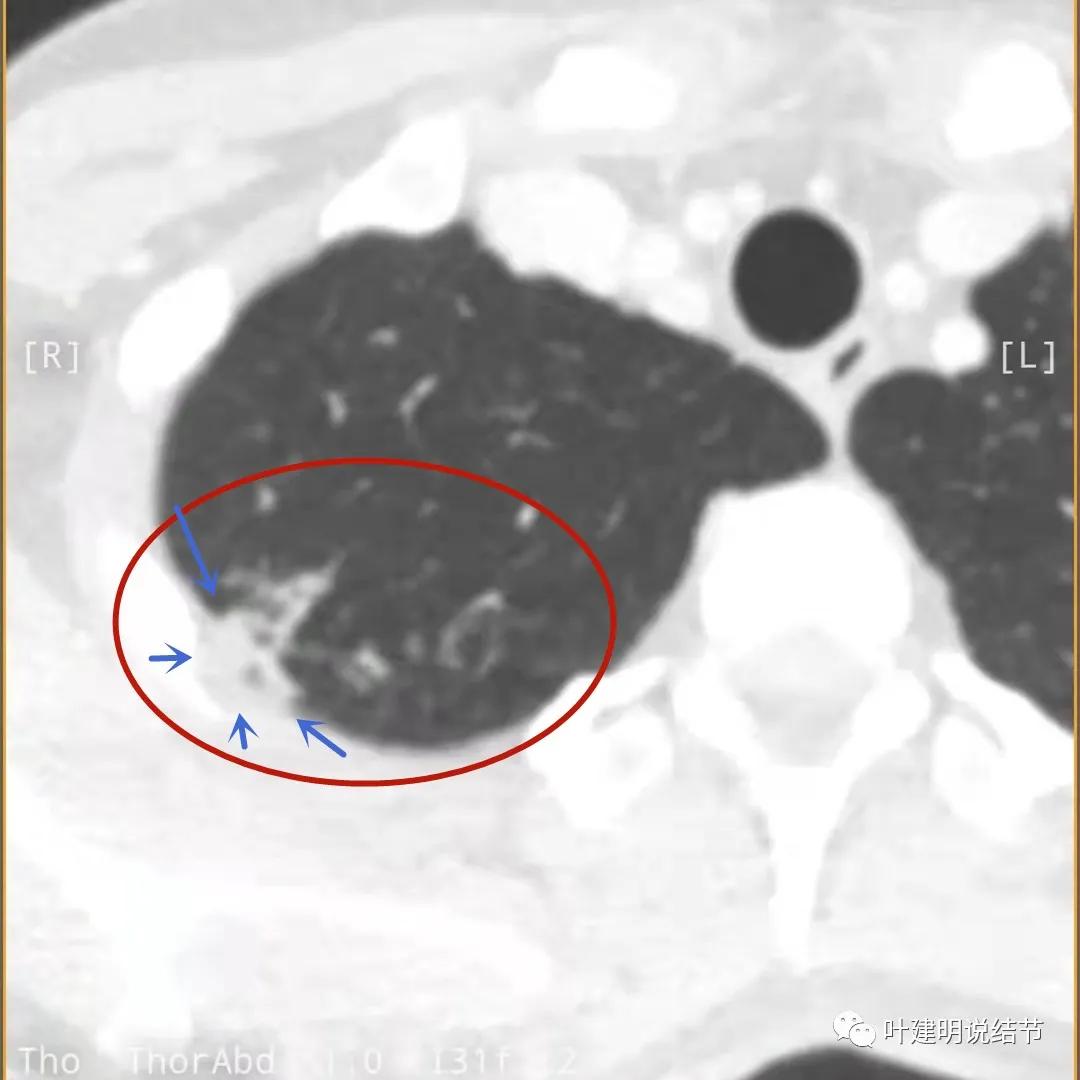 临床诊断孤立性肺结节,空洞型结节一般是什么性质
