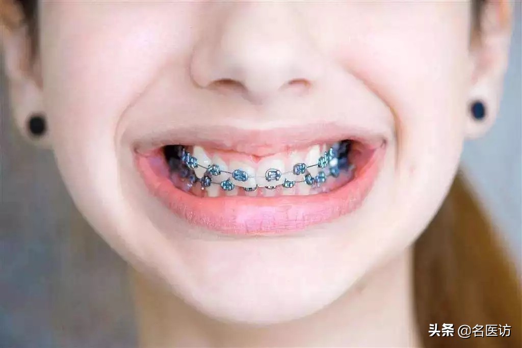 整牙矫正注意事项,整牙遇上怀孕