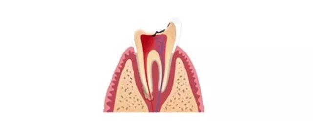 补牙补到牙齿都秃没了,补牙快到牙神经了补完咬合疼