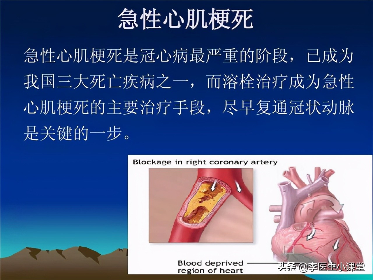 48岁心肌梗死不支架可以吗,35岁得心梗没放支架恢复很好