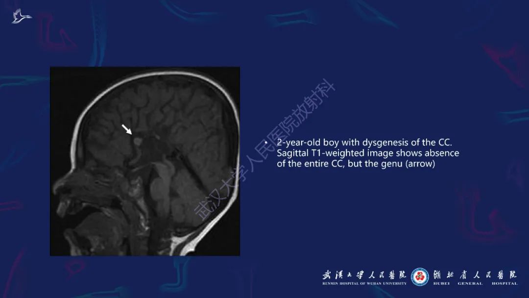 胼胝体肿瘤影像鉴别,胼胝体病变影像诊断