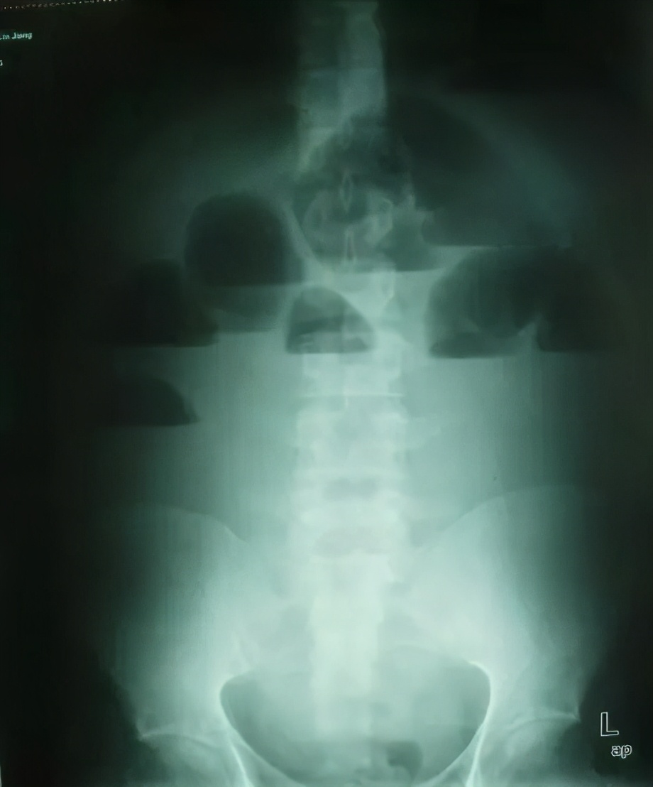 拉不出便便怎么办快速解决,拉不出便便怎么办吃什么能消化