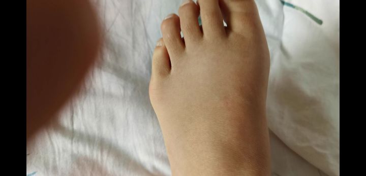 女生为什么会有大脚骨和小脚骨,大脚骨和小脚骨突出怎么办呢