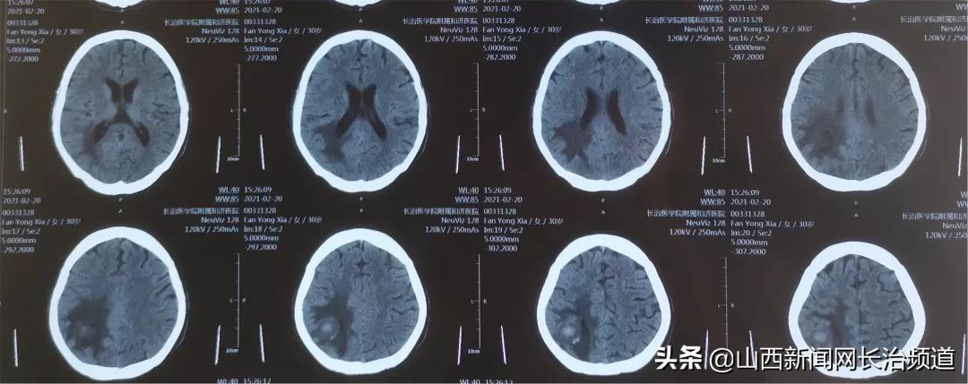 “与狼共舞”不再是梦——长治医学院附属和济医院肾内科救治一例肾衰竭合并脑出血患者