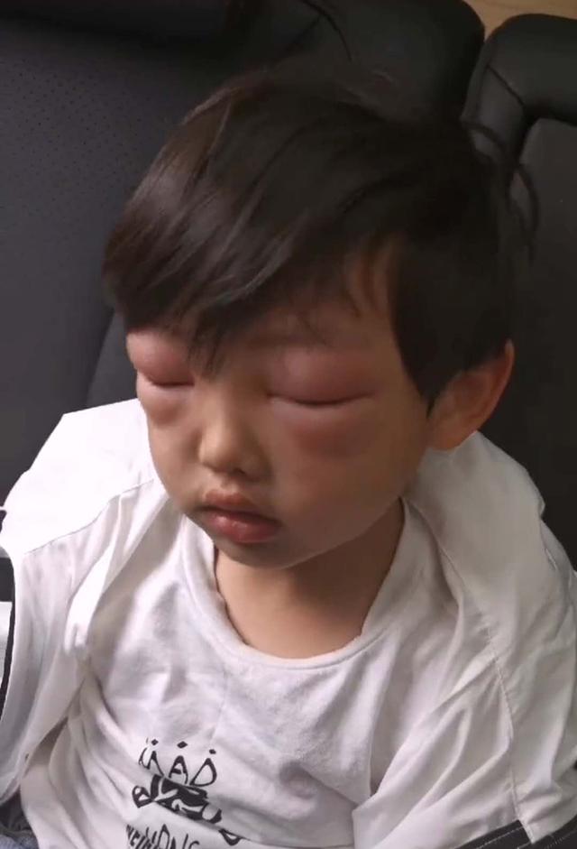 孩子是过敏体质家长可要注意了,过敏体质的娃长大后