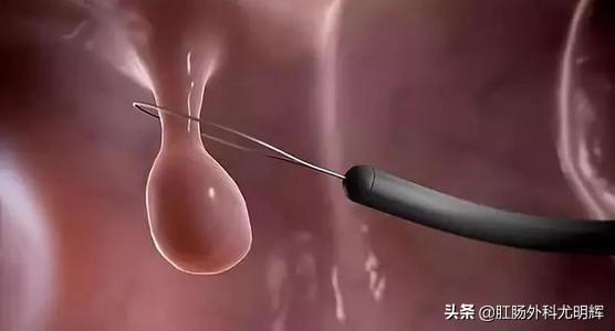 3公分肠道息肉如何切除,肠道息肉6毫米要切除吗