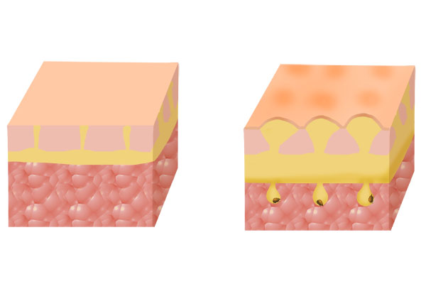 鼻翼两侧挤出白色东西怎么去除,鼻翼两侧有白色酸臭的东西是什么