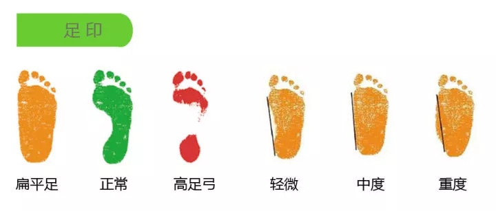 扁平足治疗手术费用,扁平足儿童专用鞋