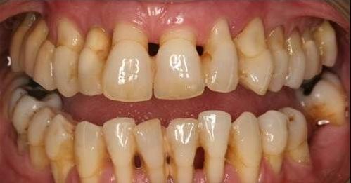 牙龈萎缩造成牙齿很松需要拔掉吗,牙龈萎缩严重导致牙齿掉