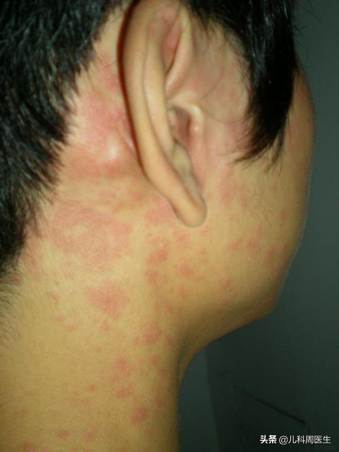 春天起水痘,如何辨别水痘和麻疹