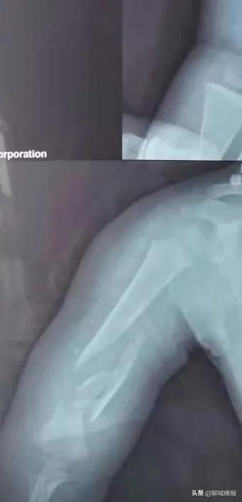 一岁多的聊城娃,牵动多地名医心