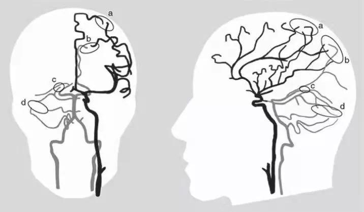 怎样判断脑血管侧支循环是否良好,有勇有谋是优点吗