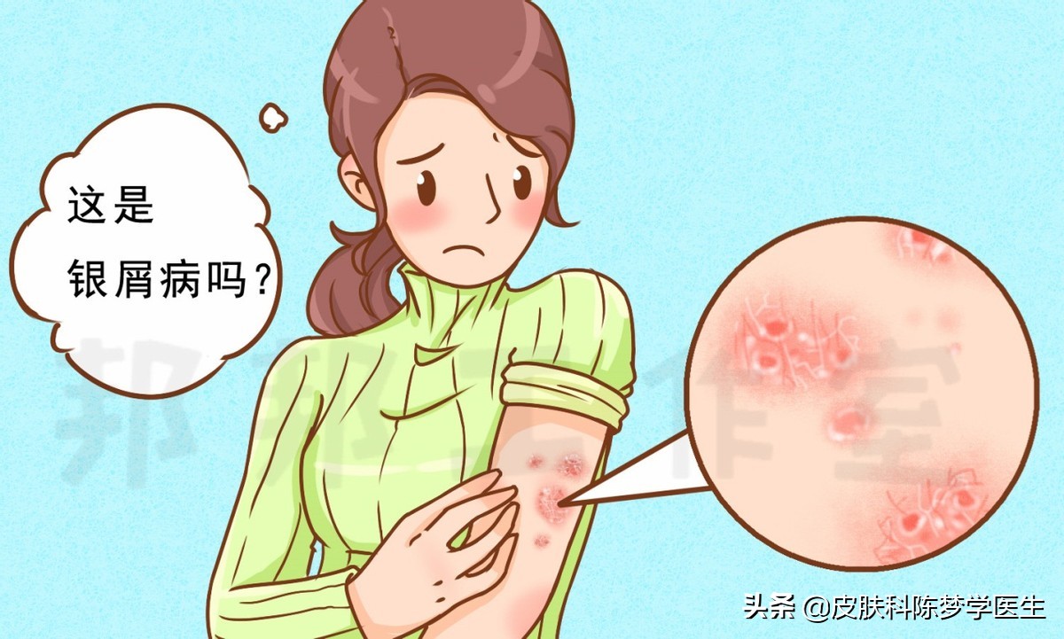 皮肤上的红斑可能是牛皮癣吗,红斑和脱屑的牛皮癣