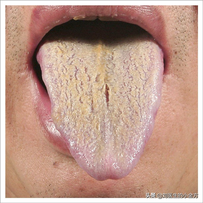 中医舌诊图解100例,中医舌诊图与舌诊口诀